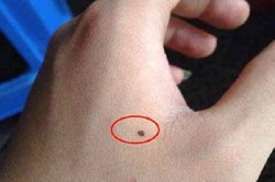 手上長痣長在手眼部位好不好呢